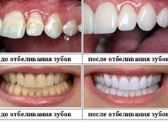 Лечение. Рецепт отбеливания и лечения зубов
