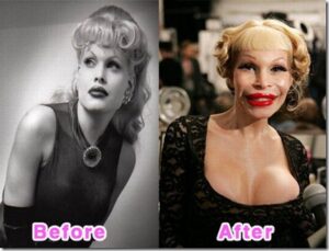 Жертвы “пластической“ красоты