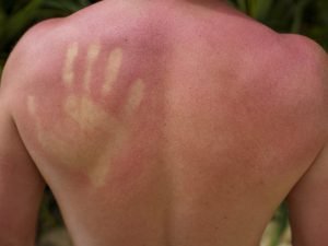 Что делать, если обгорел на солнце?