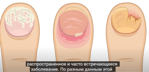 Неумывакин: ЭТОТ ПРОСТОЙ РЕЦЕПТ избавит от ГРИБКА — навсегда!  Видео