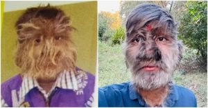 Мальчик-оборотень из Индии с очень редким заболеванием