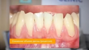 Главные причины оголения дёсен!  Видео