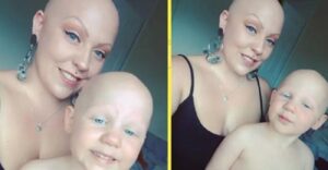 Ради дочери, которая тоже страдает алопецией, облысевшая мама решила не носить парик